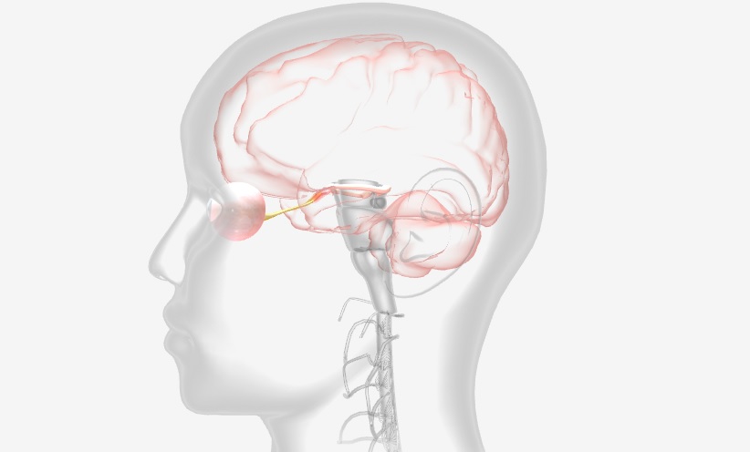 Optic Neuritis – e-CADAVIZ