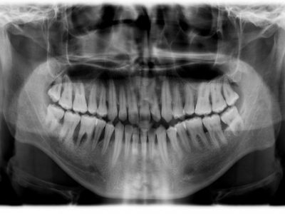 X-ray-Orthopantomography