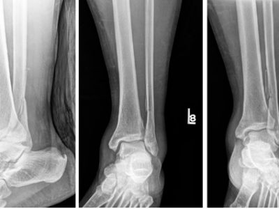 X-ray of Ankle