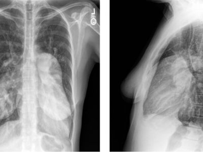 X-ray of Chest