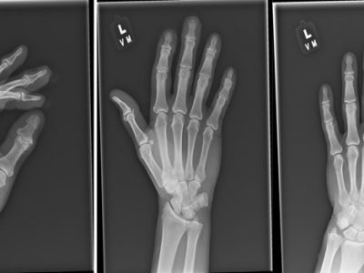 X-ray of Hand