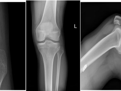 X-ray of Knee