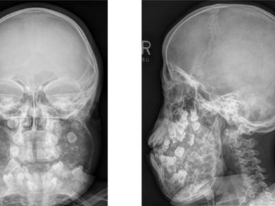 X-ray of Paranasal Sinuses 10year Old Male