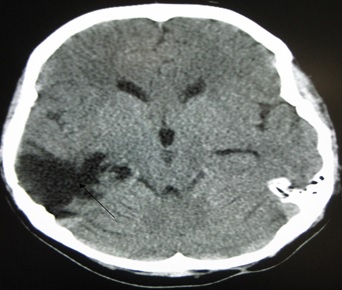 MRI Brain Injury