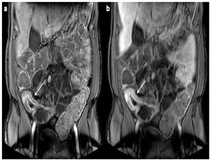 MRI Crohn’s Disease