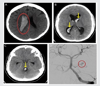 MRI Haemorrhagic Stroke