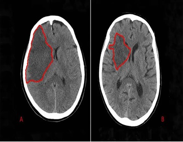 MRI Ischemic Stroke