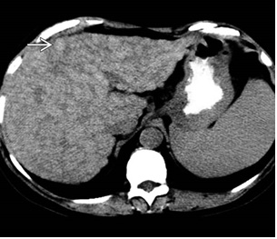 MRI Liver Cirrhosis