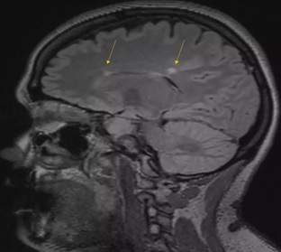 MRI Multiple Sclerosis