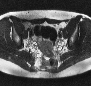 MRI PCOS