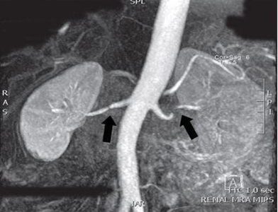 Renal Artery Stenosis